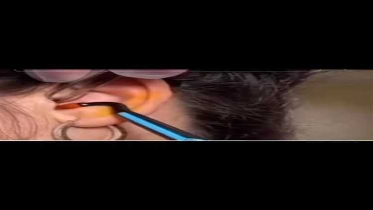 “انطقع نصفه”.. طبيب يخرج صرصور من أذن امرأة (فيديو)