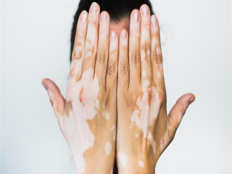 “أمل جديد” علاج واعد لمرضى البهاق