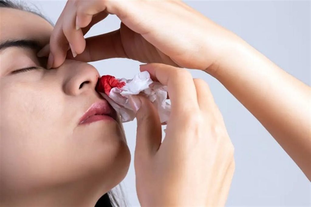 ما هي أسباب وعلاج نزيف الأنف؟