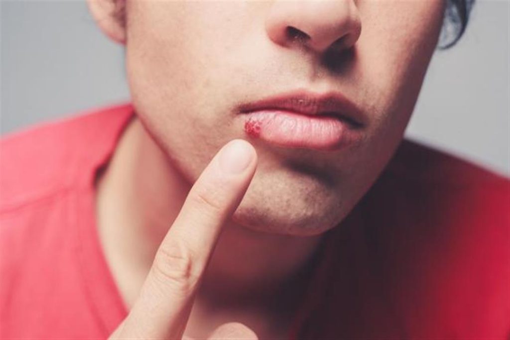 هل وصل لمرحلة الوباء.. المصل واللقاح تكشف تفاصيل تطعيم الهربس