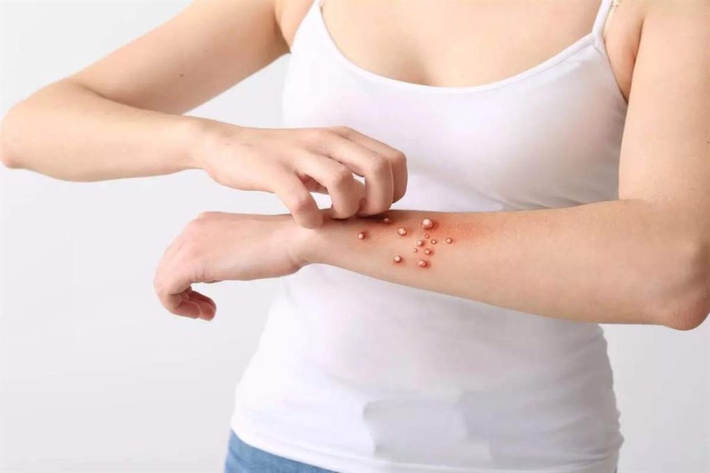 مستشفى بنها الجامعي يكشف حقيقة تسجيل أول حالة لجدري القرود