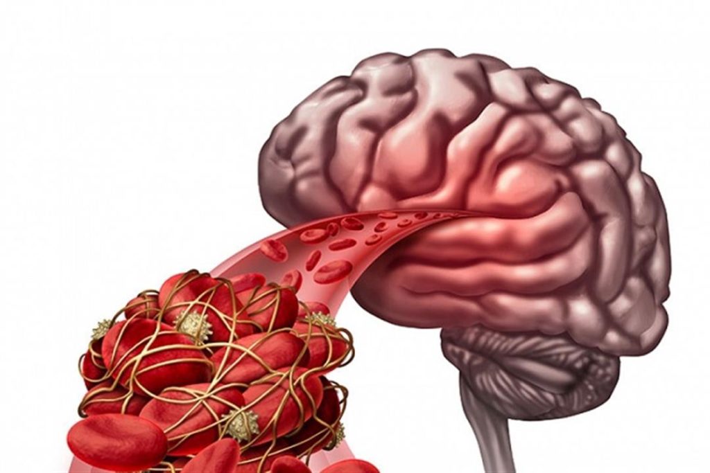 بعد إصابة “بلطجي السينما”.. تصرفات بسيطة تحميك من الجلطة الدماغية