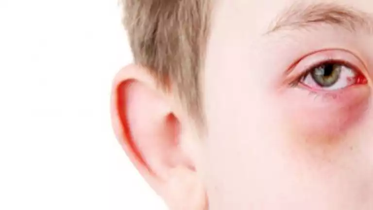 ما أسباب الكدمات تحت العينين عند الأطفال؟