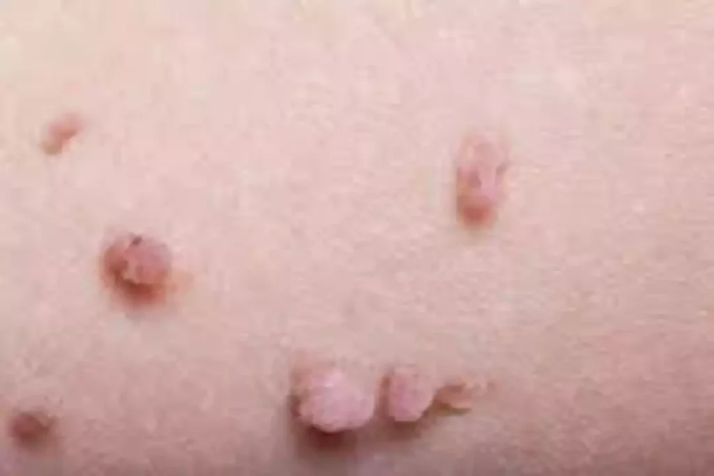 11 خرافة شائعة حول الورم الحليمي.. تعرف عليهم