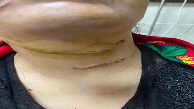 “هبة” نجت من الذبح على يد طليقها.. معجزة طبية تنقذ سيدة من محاولة قتل بشعة- صور