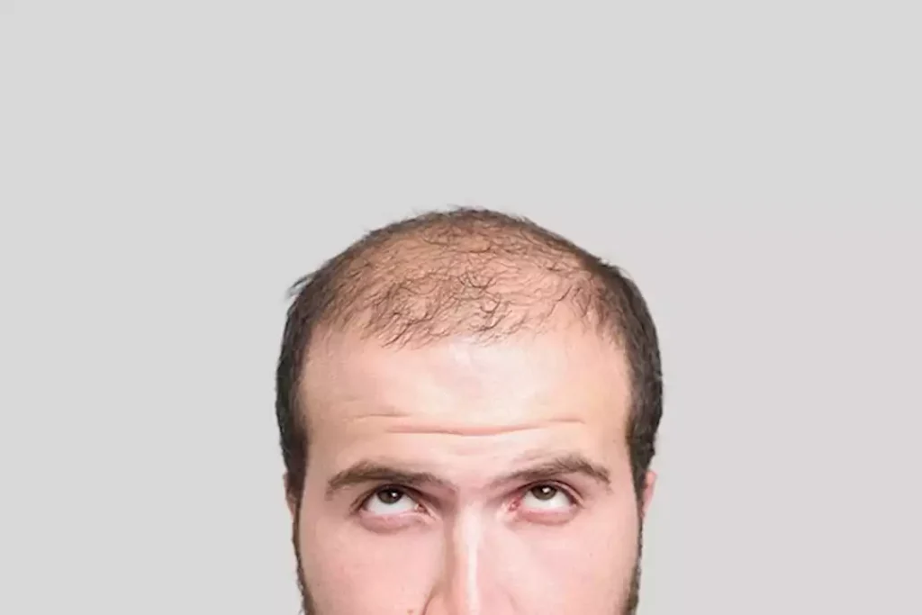 يمنع تساقط الشعر.. اكتشاف جديد قد يغير طريقة علاج الصلع