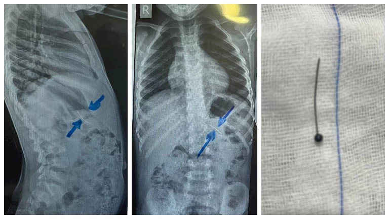 استخراج دبوس من معدة طفل في مستشفى سوهاج الجامعي -صور