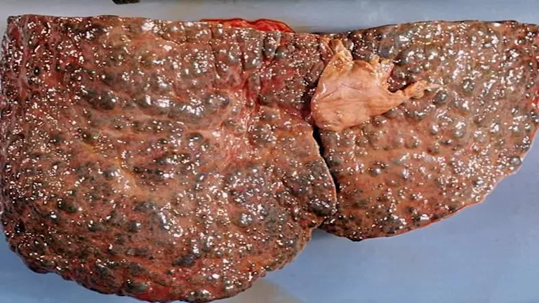 5 أعراض تشير إلى تلف الكبد الناتج عن السكري