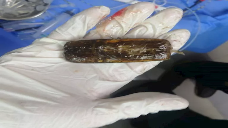 بالصور- استخراج موبايل من معدة مريض بعد عامين من ابتلاعه في أسيوط