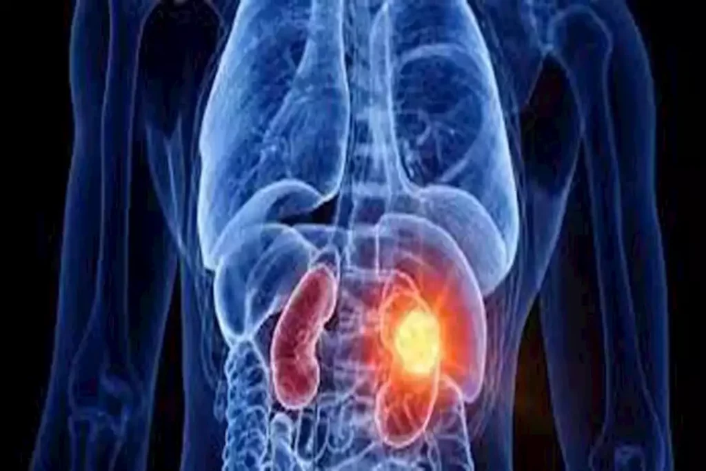 أصيب به الفنان إدوارد.. 5 علامات تكشف إصابتك بسرطان الكلى