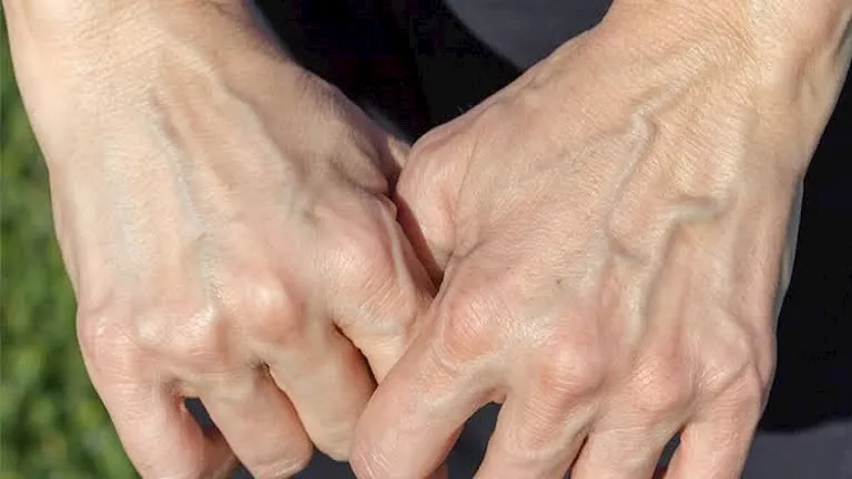 ظهور عروق اليد البارزة.. 5 حالات تستدعي الذهاب للطبيب