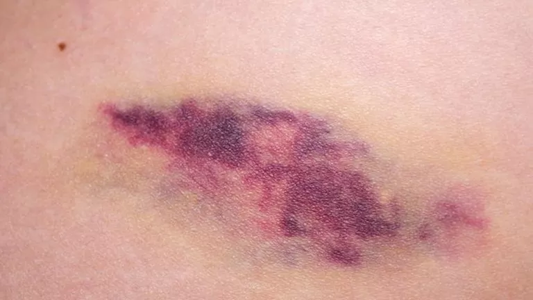 في شهر التوعية بها.. ما هي “الساركوما” وكيفية علاجها؟