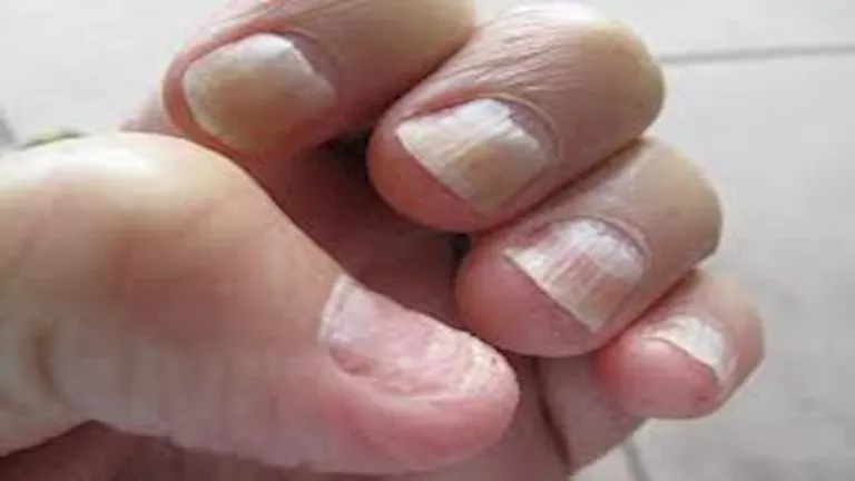 لا تلاحظها بسهولة.. 5 أعراض تدل على الإصابة بسرطان الأظافر