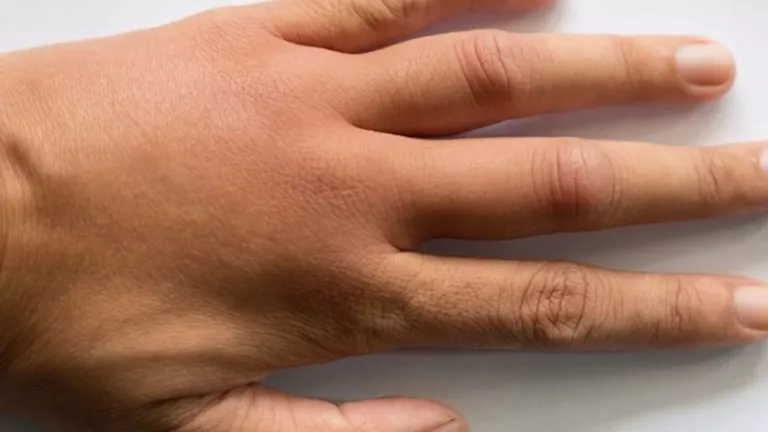 تظهر على أصابعك- 3 علامات تخبرك بأن كبدك مريض.. أعراض أمراض الكبد على