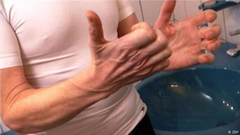 التصلب الجانبي الضموري.. الأسباب والعلامات التي يجب الانتباه لها