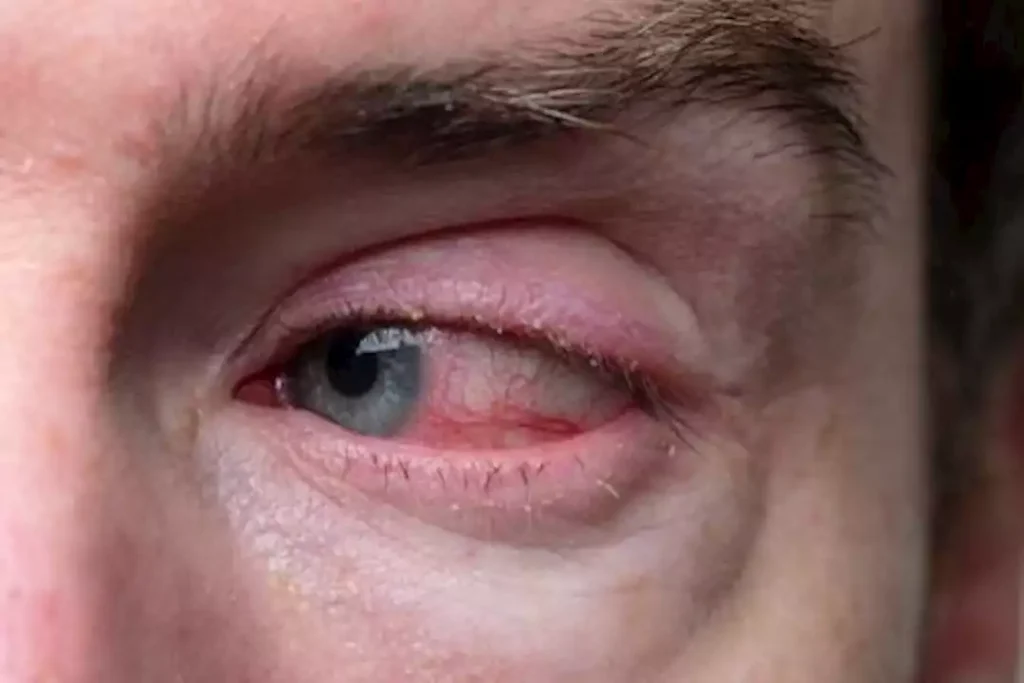 دراسة: إهمال جفاف العين قد يؤدي إلى فقدان البصر