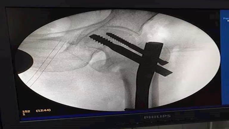 بتقنية متطورة.. نجاح جراحتين دقيقتين للعظام في مستشفى بالدقهلية (صور)