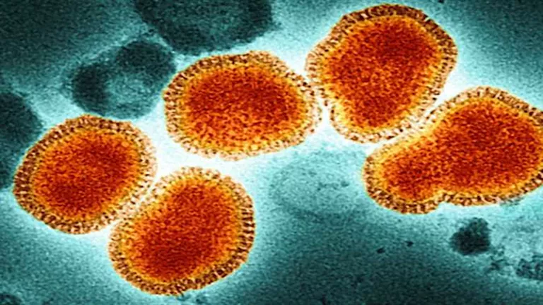 مرض جديد يثير القلق