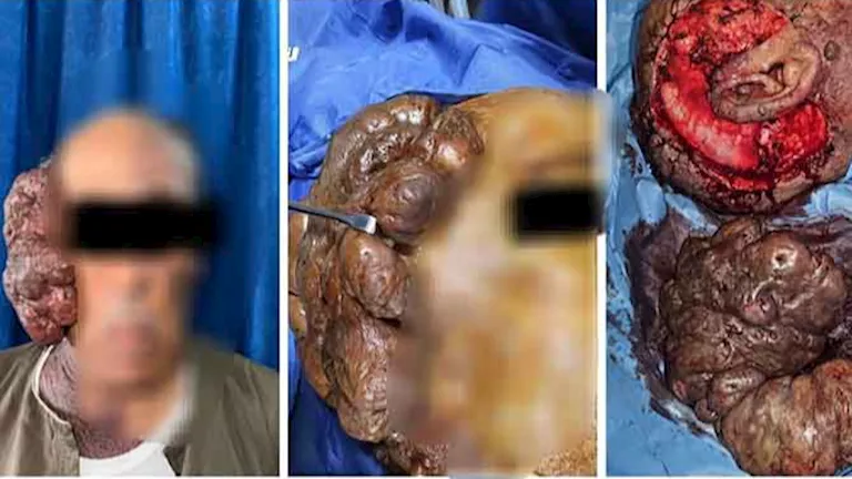 استئصال ورم ضخم يزن 2 كجم من وجه مريض بأسيوط – صور