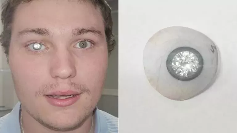 مثبتة في عينه.. صاحب متجر مجوهرات يثير الجدل بـ ماسة عيار 2 قيراط (فيد