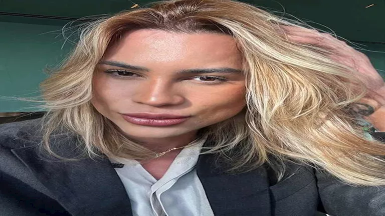 بعد وفاة مؤثر الموضة البرازيلي.. تعرف على جراحة “عيون الثعلب” ومخاطرها