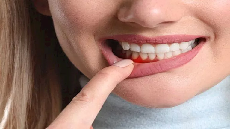 دراسة تكشف: الاكتئاب يزيد من التهاب اللثة